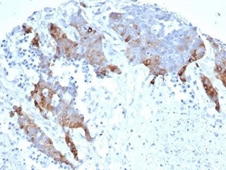 IHC staining of FFPE human ovarian carcinoma tissue with recombinant Transglutaminase 2 antibody (cl