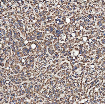 IHC staining of FFPE human liver cancer tissue with SH2D4A antibody. HIER: boil tissue sections in p