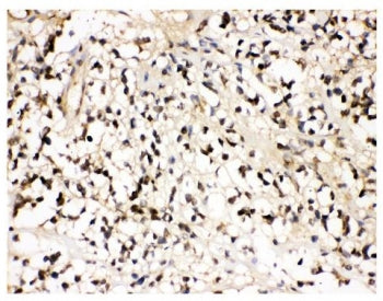 IHC staining of FFPE human glioma tissue with VCP antibody. HIER: boil tissue sections in pH8 EDTA f