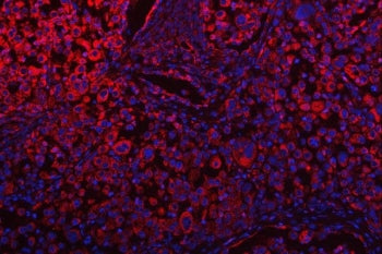 Immunofluorescent staining of FFPE human lung cancer tissue with OSGIN1 antibody (red) and DAPI nucl