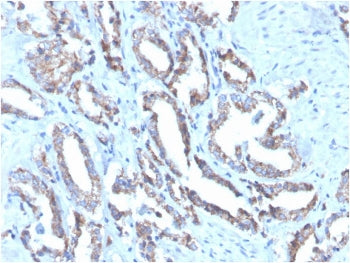IHC staining of FFPE human prostate carcinoma with Cytokeratin 7 antibody (clone OV-TL12/30). HIER: 