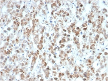 IHC staining of FFPE human colon carcinoma tissue with IL-25 antibody (clone IL25/625). HIER: boil t