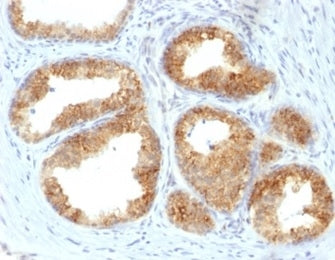 IHC staining of FFPE human prostate cancer with COX2 antibody (clone COX2/2377). HIER: boil tissue s