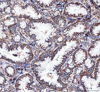 IHC staining of FFPE human lung adenocarcinoma tissue with Integrin alpha 3 antibody. HIER: boil tis