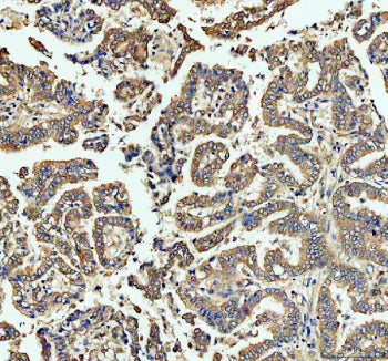 Immunohistochemical staining of FFPE human lung cancer tissue with ECE1 antibody, HRP-secondary and 