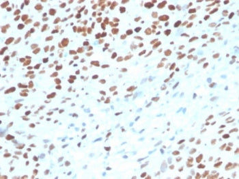 IHC staining of FFPE human bladder tissue with TP53 antibody (clone rTP53/3889). HIER: boil tissue s