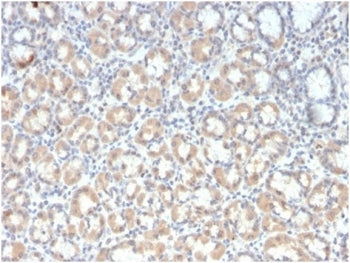 IHC staining of FFPE human gastric carcinoma tissue with recombinant Mucin-3 antibody (clone rMUC3/1