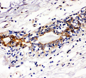 IHC staining of FFPE human breast cancer with c-Kit antibody. HIER: boil tissue sections in pH6, 10m