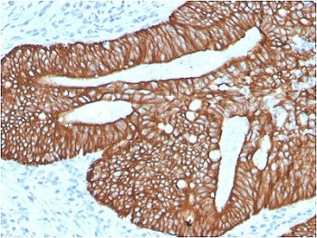 IHC staining of FFPE human colon carinoma with recombinant Cytokeratin 18 antibody (clone KRT18/2819