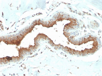 IHC staining of FFPE human breast carcinoma with Mammaglobin antibody (clone MGB/2704). HIER: boil t