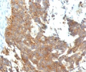 IHC: Formalin-fixed, paraffin-embedded human ovarian carcinoma stained with GnRH Receptor antibody (