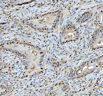 IHC staining of FFPE human rectum adenocarcinoma tissue with PSMA1 antibody. HIER: boil tissue secti