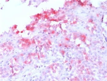 IHC testing FFPE human melanoma with recombinant Melan-A antibody (clone MLANA/1761R). HIER: steam s