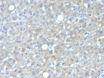IHC staining of FFPE human hepatocellular carcinoma tissue with Glypican-3 antibody (clone GPC3/7419