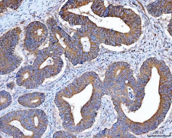 IHC staining of FFPE human rectal cancer tissue with Src antibody. HIER: boil tissue sections in pH8