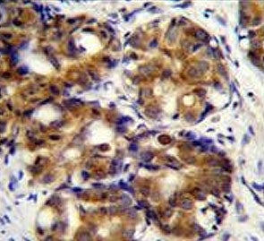 IHC testing of FFPE human breast carcinoma tissue with CD168 antibody. HIER: steam section in pH6 ci