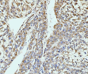 IHC staining of FFPE human liver cancer tissue with GIT1 antibody. HIER: boil tissue sections in pH8