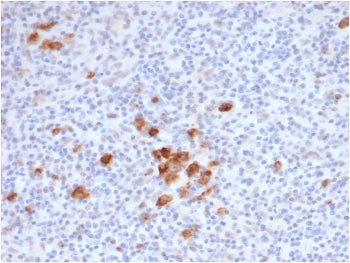 IHC staining of FFPE human Hodgkins lymphoma tissue with recombinant CD30 antibody (clone rKi-1/6913