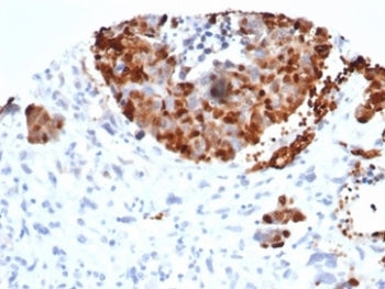 IHC staining of FFPE human bladder carcinoma tissue with recombinant INSM1 antibody (clone INSM1/628