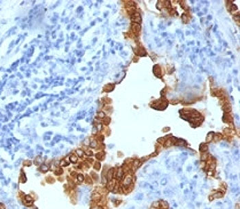 IHC analysis of formalin-fixed, paraffin-embedded human lung carcinoma stained with Cytokeratin 8/18