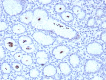 IHC staining of FFPE human H. pylori-infected stomach tissue with Helicobacter pylori antibody (clon