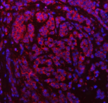 Immunofluorescent staining of FFPE human breast cancer tissue with SDF2L1 antibody (red) and DAPI nu