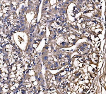 IHC staining of FFPE human liver cancer tissue with LSR antibody. HIER: boil tissue sections in pH8 