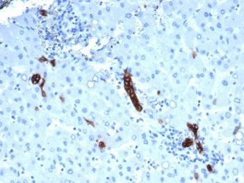 IHC staining of FFPE human colorectal liver metastasis with recombinant TROP2 antibody (clone rTACST