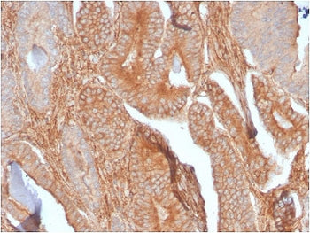 IHC staining of FFPE human prostate carcinoma with recombinant CD81 antibody (clone C81/2885R). HIER