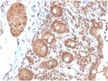 IHC staining of FFPE human colon carcinoma tissue with Interleukin 3 antibody (clone IL3/4004). HIER