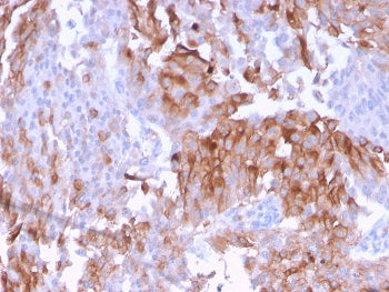 IHC staining of FFPE human urothelial carcinoma with UPK1B antibody. HIER: boil tissue sections in p