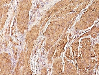IHC: Formalin-fixed, paraffin-embedded human Leiomyosarcoma stained with Muscle Specific Actin antib