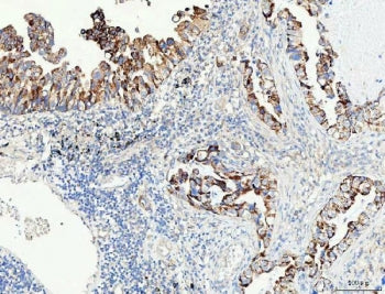 IHC staining of FFPE human lung adenocarcinoma tissue with Proline dehydrogenase 1 antibody. HIER: b