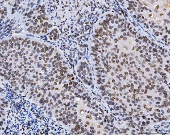 IHC staining of FFPE human laryngeal squamous cell carcinoma tissue with Lamin A/C antibody. HIER: b