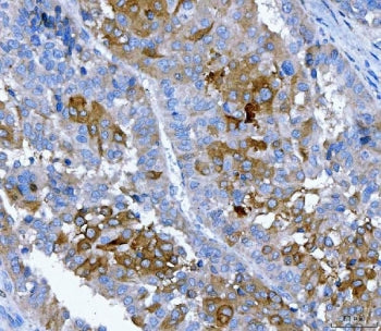 IHC staining of FFPE human liver cancer tissue with FGFR2 antibody. HIER: boil tissue sections in pH