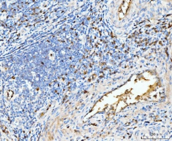 IHC staining of FFPE moderately differentiated adenocarcinoma of the rectum tissue with Hemoglobin a