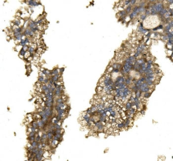 IHC staining of FFPE human renal cancer with Arginase 2 antibody. HIER: boil tissue sections in pH8 