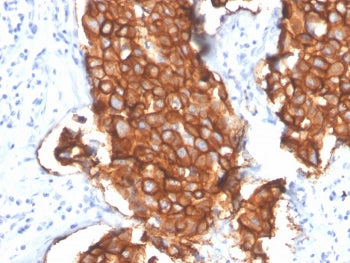 IHC staining of FFPE human breast carcinoma with HER2 antibody (clone ERBB2/4439R). HIER: boil tissu