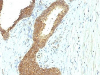 IHC testing of FFPE human colon carcinoma with Alkaline Phosphatase antibody (ALPL/597). Required HI
