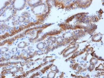 IHC testing of FFPE human thyroid carcinoma with TSH Receptor antibody (clone SPM222). Required HIER