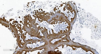 IHC staining of FFPE human ovarian cancer with Phospholipid transfer protein antibody. HIER: boil ti