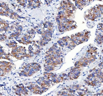 IHC staining of FFPE human liver cancer tissue with Amyloid-like protein 2 antibody. HIER: boil tissue sections in pH8 EDTA for 20 min and allow to cool before testing.
