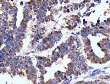 IHC staining of FFPE human ovarian cancer tissue with Neurofibromin antibody. HIER: boil tissue sect