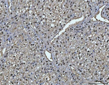 IHC staining of FFPE human liver cancer tissue with Fumarylacetoacetate hydrolase antibody. HIER: bo
