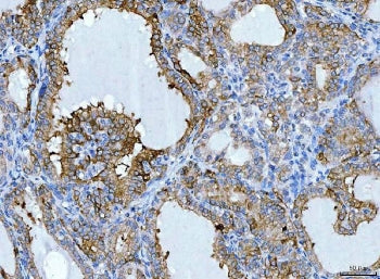IHC staining of FFPE human thyroid cancer tissue with Keratin 7 antibody. HIER: boil tissue sections
