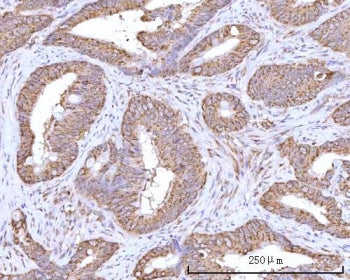 IHC staining of FFPE human rectum adenocarcinoma tissue with RPN1 antibody. HIER: boil tissue sectio