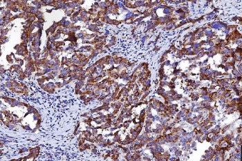 IHC staining of FFPE human ovarian cancer tissue with HRS antibody. HIER: boil tissue sections in pH