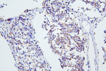 IHC staining of FFPE human glioma with mGluR1 antibody. HIER: boil tissue sections in pH8 EDTA for 2