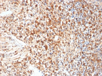 IHC staining of FFPE human cervix with HSV1 antibody (clone HSVI/2095). Required HIER: boil tissue s