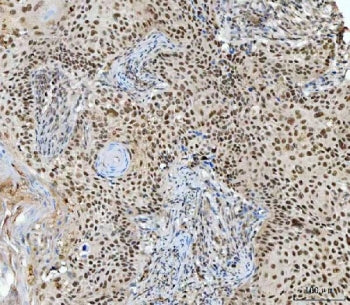 IHC staining of FFPE human laryngeal squamous carcinoma tissue with RING2 antibody. HIER: boil tissu